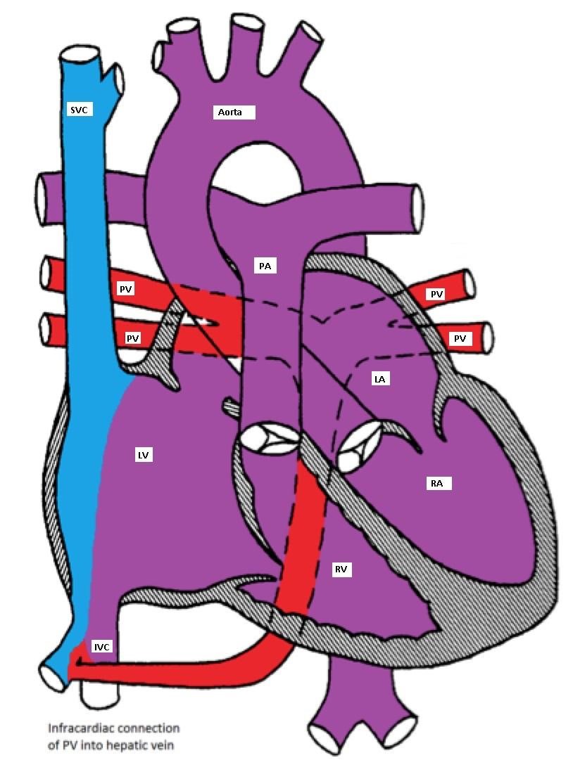 Infracardiac type TAPVC